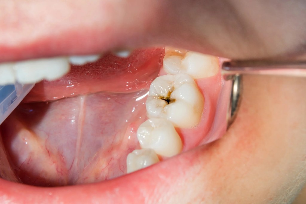 Dentist Inspecting Cavity For Dental Filling